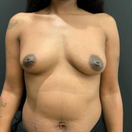 Before image 1 Case #103346 - Breast Augmentation with 470 cc implants
