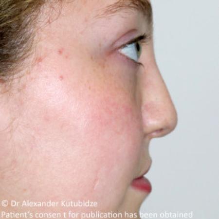 Before image 6 Case #103356 - One year after repair of the unilateral cleft lip/nose deformity