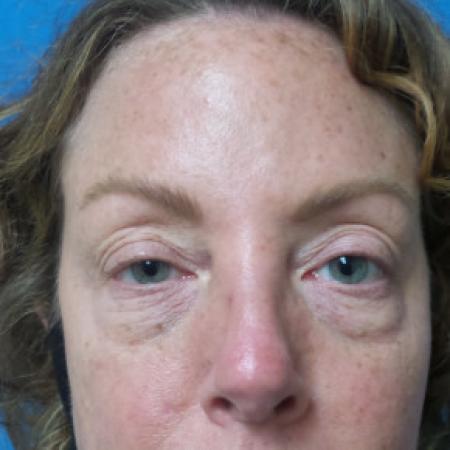 Before image 1 Case #102256 - 44 year old -  Upper Blepharoplasty with Ptosis repair and Transconjunctival Lower Blepharoplasty