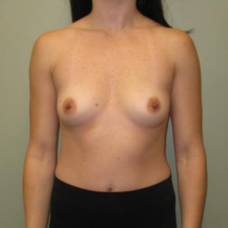 Before image 1 Case #103381 - 25-34 year old woman treated with Breast Augmentation