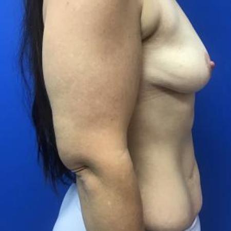 Before image 2 Case #103316 - DIEP Flap and Phasix Mesh to the abdomen for a 31 year old female