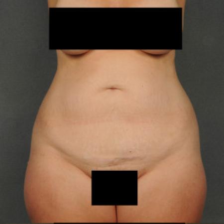 Before image 1 Case #101591 - Abdominoplasty