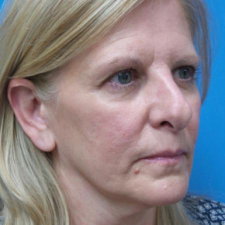 Before image 2 Case #102241 - 56 year old  -  Open Rhinoplasty/Septoplasty/Turbinectomy  -  5 months post-op