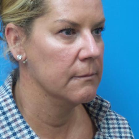 Before image 2 Case #102331 - 52 year old  -  Facelift/Neck Lift/Upper Blepharoplasty  - 3 months post-op