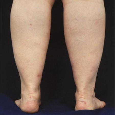 Before image 3 Case #102686 - Lower Leg Liposuction