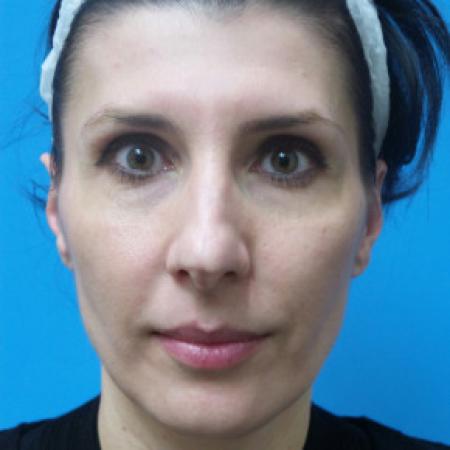 Before image 3 Case #102201 - 42 year old - Open Septo Rhinoplasty  -  7 months post-op