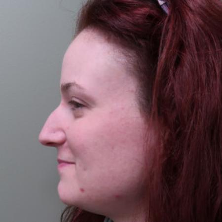 Before image 2 Case #103391 - Rhinoplasty