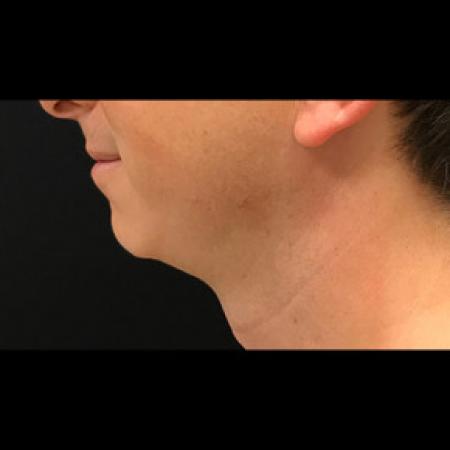 Before image 1 Case #101561 - CHIN IMPLANT