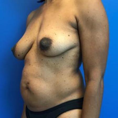 Before image 2 Case #103306 - Mastopexy with autologous fat grafting to breasts and aAbdominoplasty for a 45 year old female
