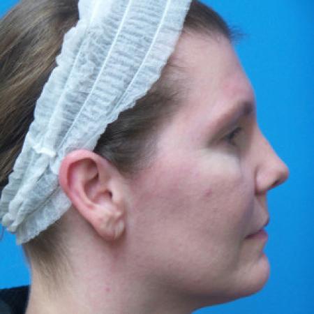 Before image 2 Case #102231 - 39 year old  -  Endoscopic Browlift    5 months post-op