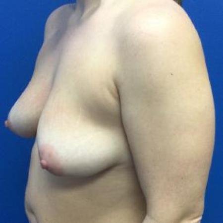 Before image 2 Case #103331 - Silicone Breast Augmentation & Mastopexy for a 29 year old female