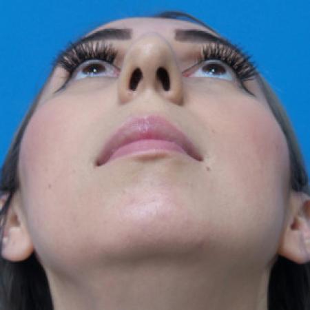 Before image 4 Case #102206 - 30 year old  -  Open Rhinoplasty & Chin Augmentation   3 months post-op