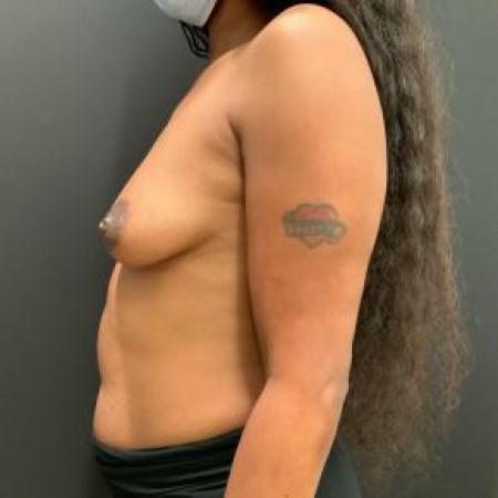 Before image 3 Case #103346 - Breast Augmentation with 470 cc implants