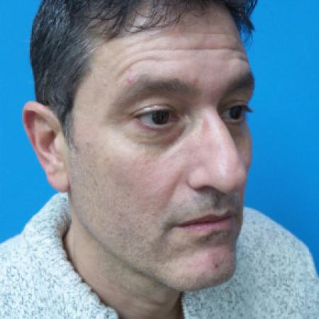 Before image 2 Case #102161 - 54 year-old  -  Rhinoplasty/Septoplasty/Turbinectomy   4 weeks post-op