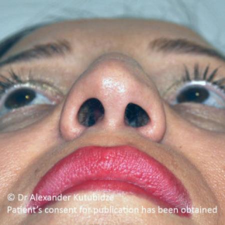 Before image 6 Case #103366 - 8 years after aging aesthetic functional rhinoplasty secondary to previous teen age septoplasty 