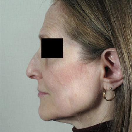 Before image 2 Case #103151 - Rhinoplasty Patient 58