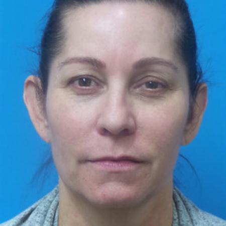 Before image 1 Case #102166 - 53 year old  -  Facelift/Upper Blepharoplasty/TCA Peel to Lower lids/Otoplasty  -  2 months post-op