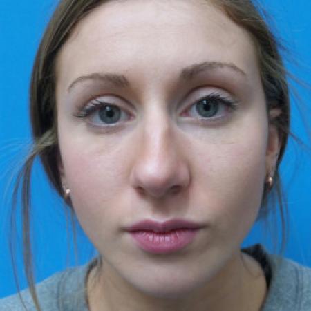 Before image 1 Case #102171 - 18 year old - Open Rhinoplasty w/submucous resection/Septoplasty & Spreader grafts to improve airway 