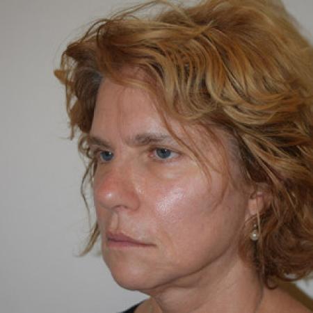 Before image 2 Case #101576 - Facelift
