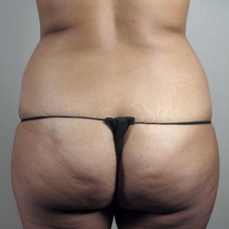 Before image 5 Case #103186 - Mommy Makeover Patient 30 