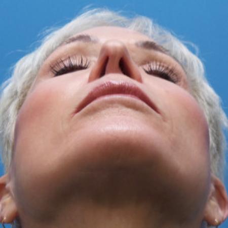 Before image 4 Case #102246 - 65 year old  -  Open Secondary Rhinoplasty. Revision from another surgeon    1 month post-op