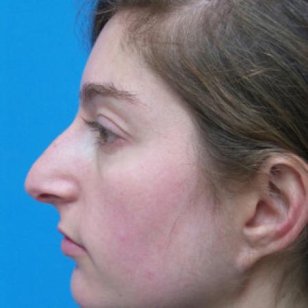 Before image 3 Case #102271 - 28 year old  -  Open Rhinoplasty  -  6 months post-op
