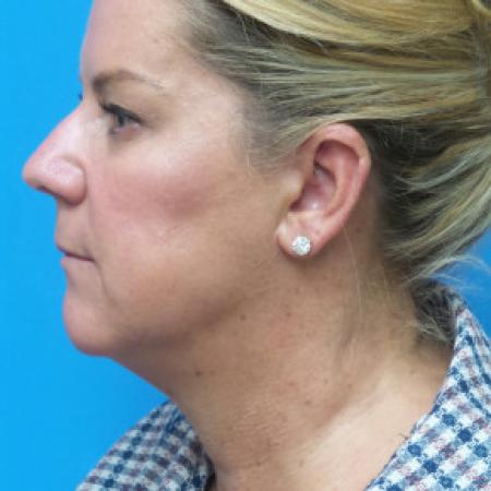 Before image 3 Case #102331 - 52 year old  -  Facelift/Neck Lift/Upper Blepharoplasty  - 3 months post-op