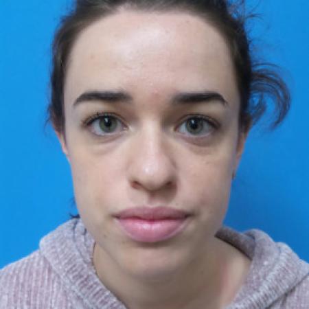 Before image 1 Case #102236 - 22 year old  -  Open Rhinoplasty  -  3 months post-op