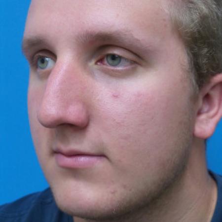 Before image 2 Case #102296 - 19 year old  -  Open Septo-Rhinoplasty with Inferior Turbinectomies  -  3 months post-op