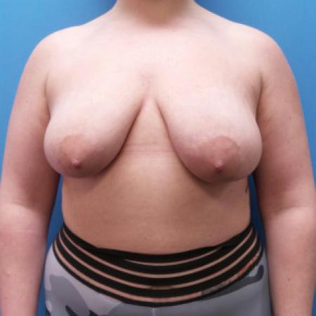 Before image 1 Case #102291 - 29 year old  -  Bilateral Breast Lift  -  4 months post-op