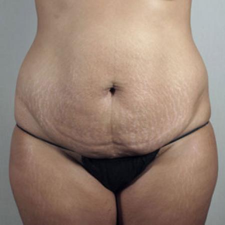 Before image 4 Case #103186 - Mommy Makeover Patient 30 