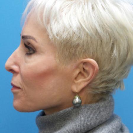 Before image 3 Case #102246 - 65 year old  -  Open Secondary Rhinoplasty. Revision from another surgeon    1 month post-op