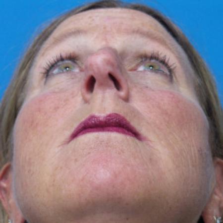 Before image 4 Case #102276 - 55 year old - This patient presented with exposed bone after sustaining an open nasal bone fracture.