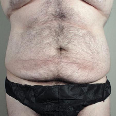 Before image 1 Case #103176 - Tummy Tuck / Body Lift Patient 1