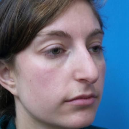 Before image 2 Case #102271 - 28 year old  -  Open Rhinoplasty  -  6 months post-op