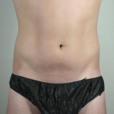 Before image 1 Case #103131 - Liposuction of the Abdomen & Flanks Patient 70