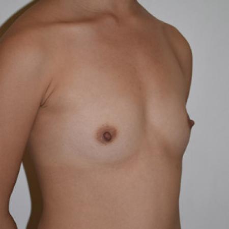 Before image 2 Case #101581 - Breast Augmentation