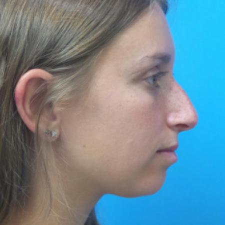 Before image 3 Case #102191 - 22 year old  -  Rhinoplasty/Septoplasty/Turbinectomy  -  1 month post-op