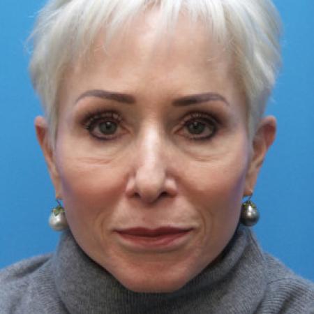 Before image 1 Case #102246 - 65 year old  -  Open Secondary Rhinoplasty. Revision from another surgeon    1 month post-op