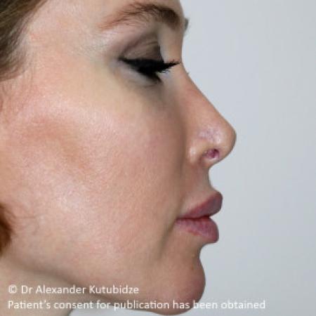 Before image 5 Case #103351 - Revision Rhinoplasty. 3 years after
