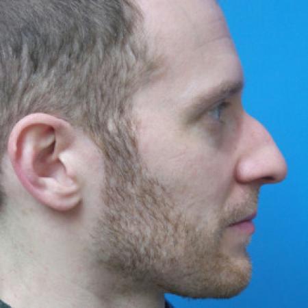 Before image 1 Case #102251 - 31 year old  -  Open Rhinoplasty  -  3 months post-op