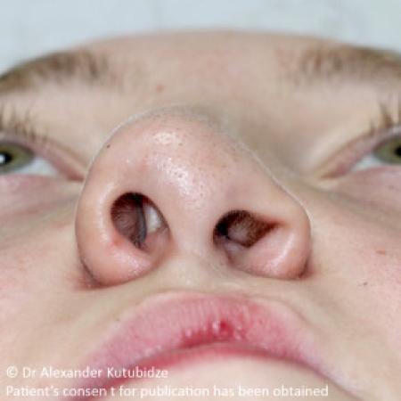 Before image 4 Case #103356 - One year after repair of the unilateral cleft lip/nose deformity