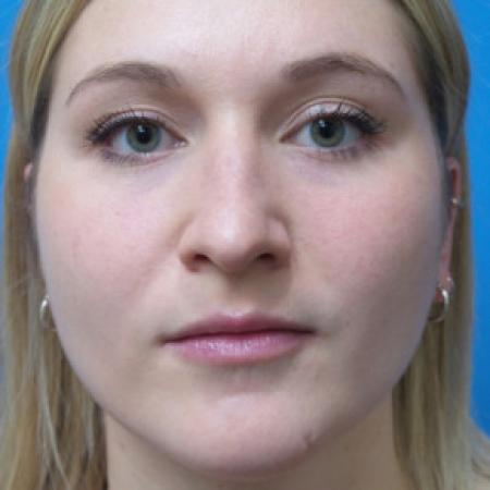 Before image 1 Case #102306 - 25 year old  -  Open Rhinoplasty  -  6 months post-op