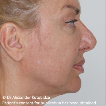 Before image 5 Case #103361 - Deep Plane Face Lifting