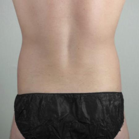 Before image 3 Case #103131 - Liposuction of the Abdomen & Flanks Patient 70