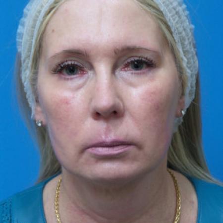 Before image 1 Case #102321 - 60 year old  -  Necklift & Facelift  -  3 months post-op