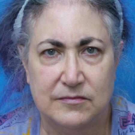 Before image 1 Case #102216 - 66 year old   -  Facelift/Upper Blepharoplasty  -  3 1/2 months post-op