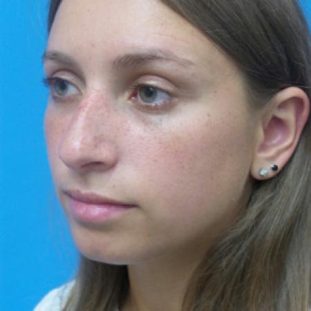 Before image 2 Case #102191 - 22 year old  -  Rhinoplasty/Septoplasty/Turbinectomy  -  1 month post-op