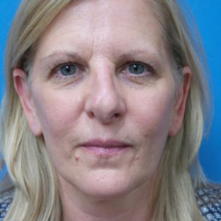 Before image 1 Case #102241 - 56 year old  -  Open Rhinoplasty/Septoplasty/Turbinectomy  -  5 months post-op