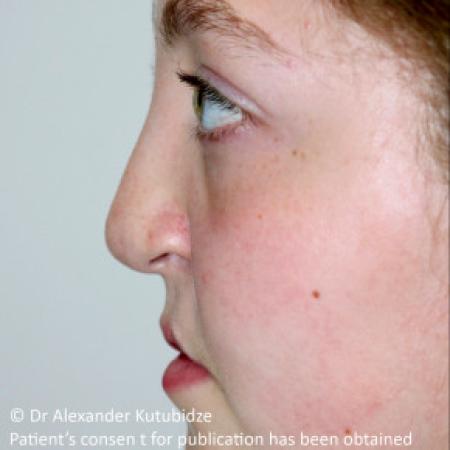 Before image 5 Case #103356 - One year after repair of the unilateral cleft lip/nose deformity